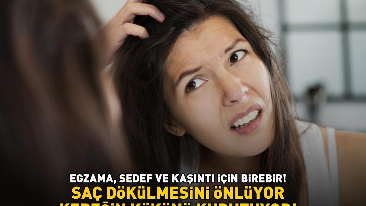 Egzama, kaşıntı ve sedef için birebir! Faydaları saymakla bitmiyor: ‘SAÇ DÖKÜLMESİNİ ÖNLÜYOR, KEPEĞİN KÖKÜNÜ KURUTUYOR’